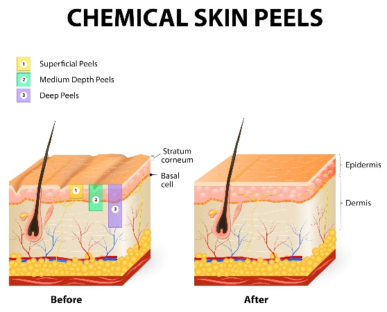 Chemical Peel Mount Martha