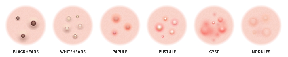 Acne Types