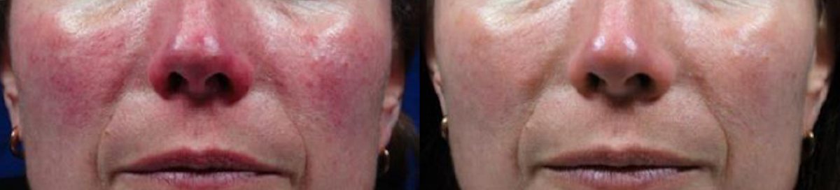 Rosacea Treatment Mount Martha